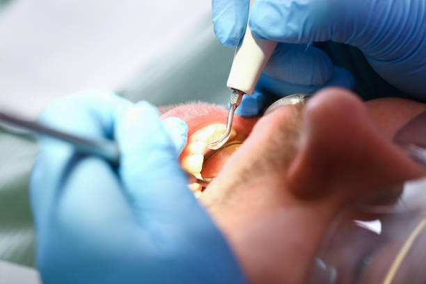 Best Emergency Wisdom Teeth Removal in Dearborn, MI